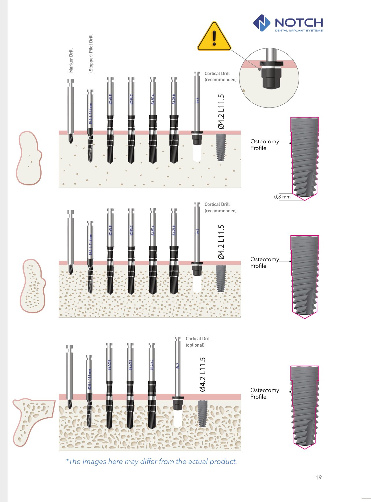 UNIQUE&trade; official drilling protocol diagram — D1, D2, D3